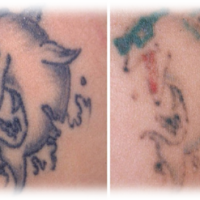 tattoo verwijderen 2